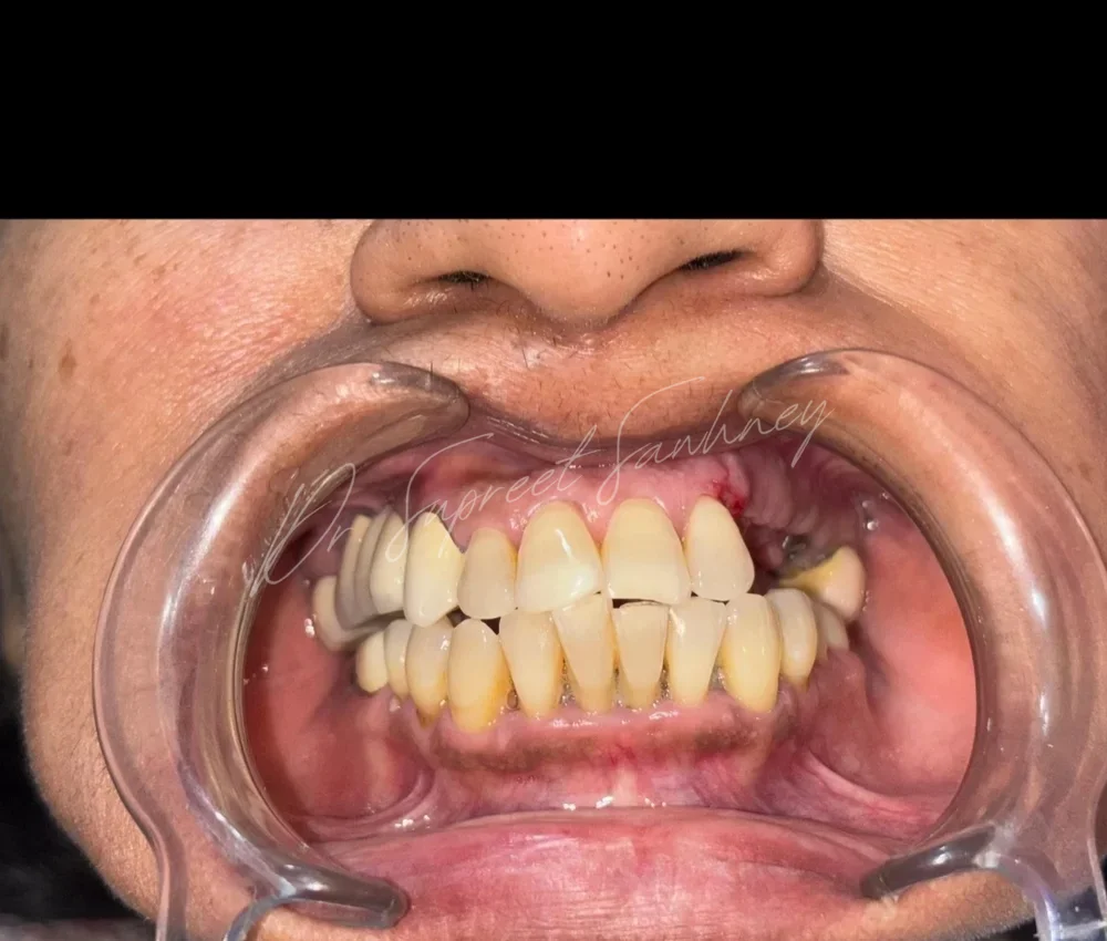 Frontal retracted intraoral photograph showing existing upper fixed restorations